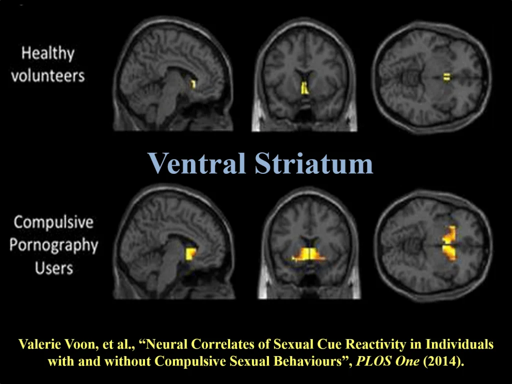 Correlacións neuronais da reactividade de sinal sexual en individuos con e sen comportamentos sexuais compulsivos
